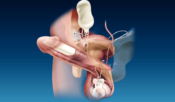Fillers for the thickness of silicone and gel