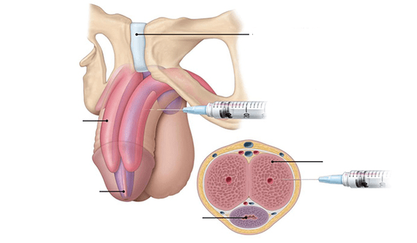 Injection of your own adipose tissue for penis thickness